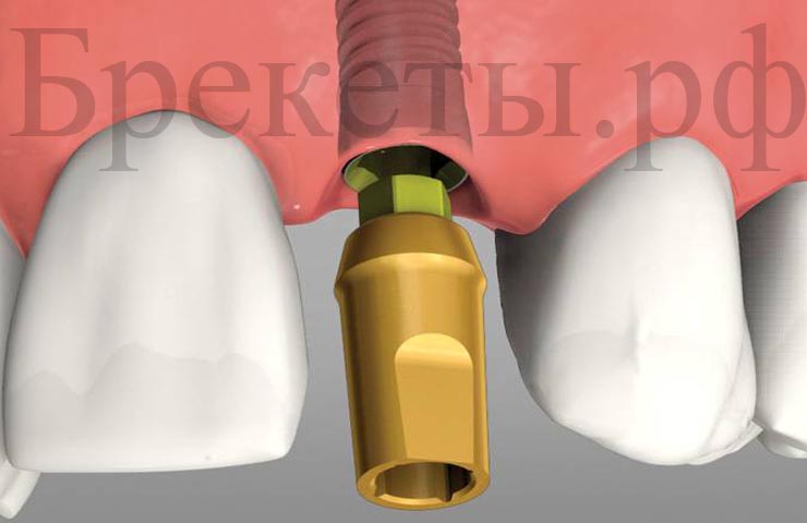 зубная имплантация и методы