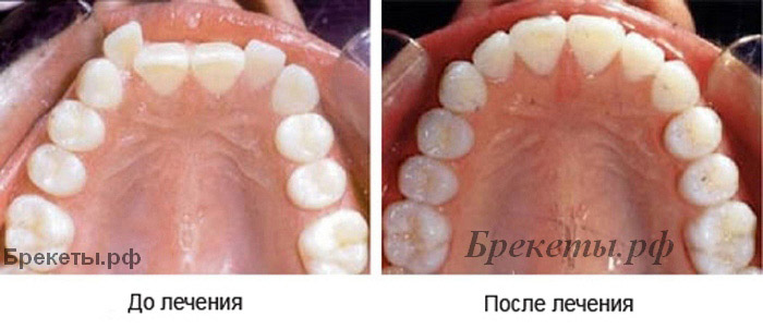 ортодонтия зубов