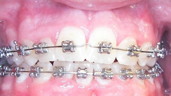 исправление скученности зубов