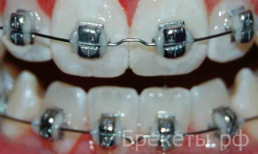 удаление зубов и брекеты